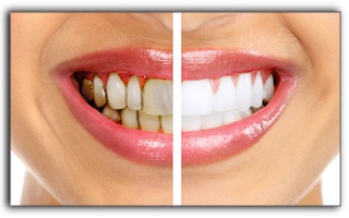 dentist-3-tooth-stains | Parkview Dental | Dentist Royal Oak, MI