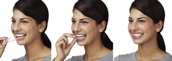 Invisalign | Parkview Dental | Dentist Royal Oak, MI