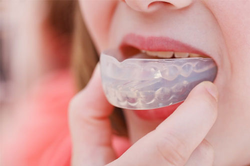 mouthguards_2 | Parkview Dental - Royal Oak, MI